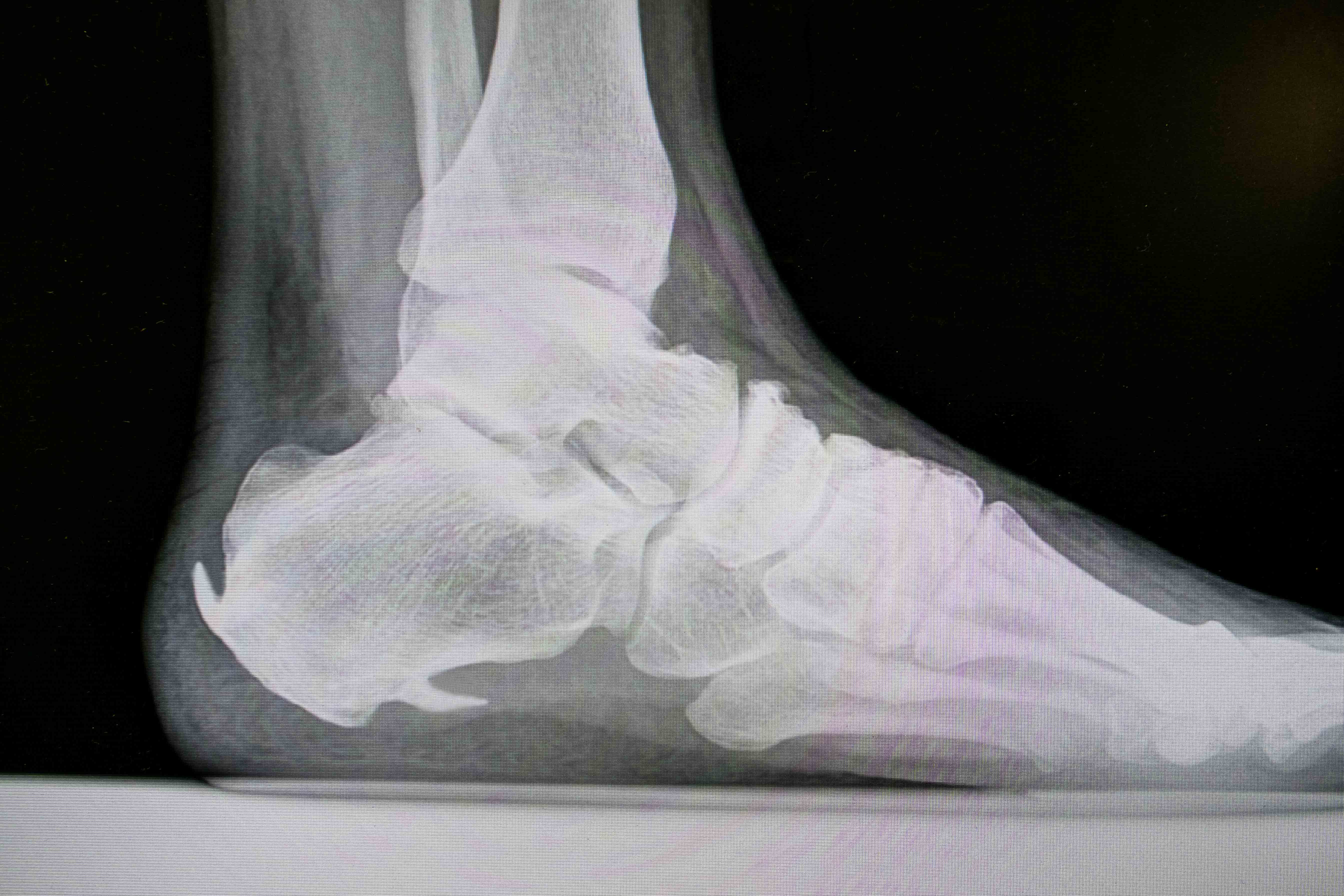 bone spur heel
