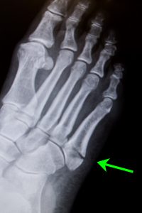 Ankle sprain ankle injury