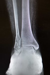 ankle doctor ankle injury